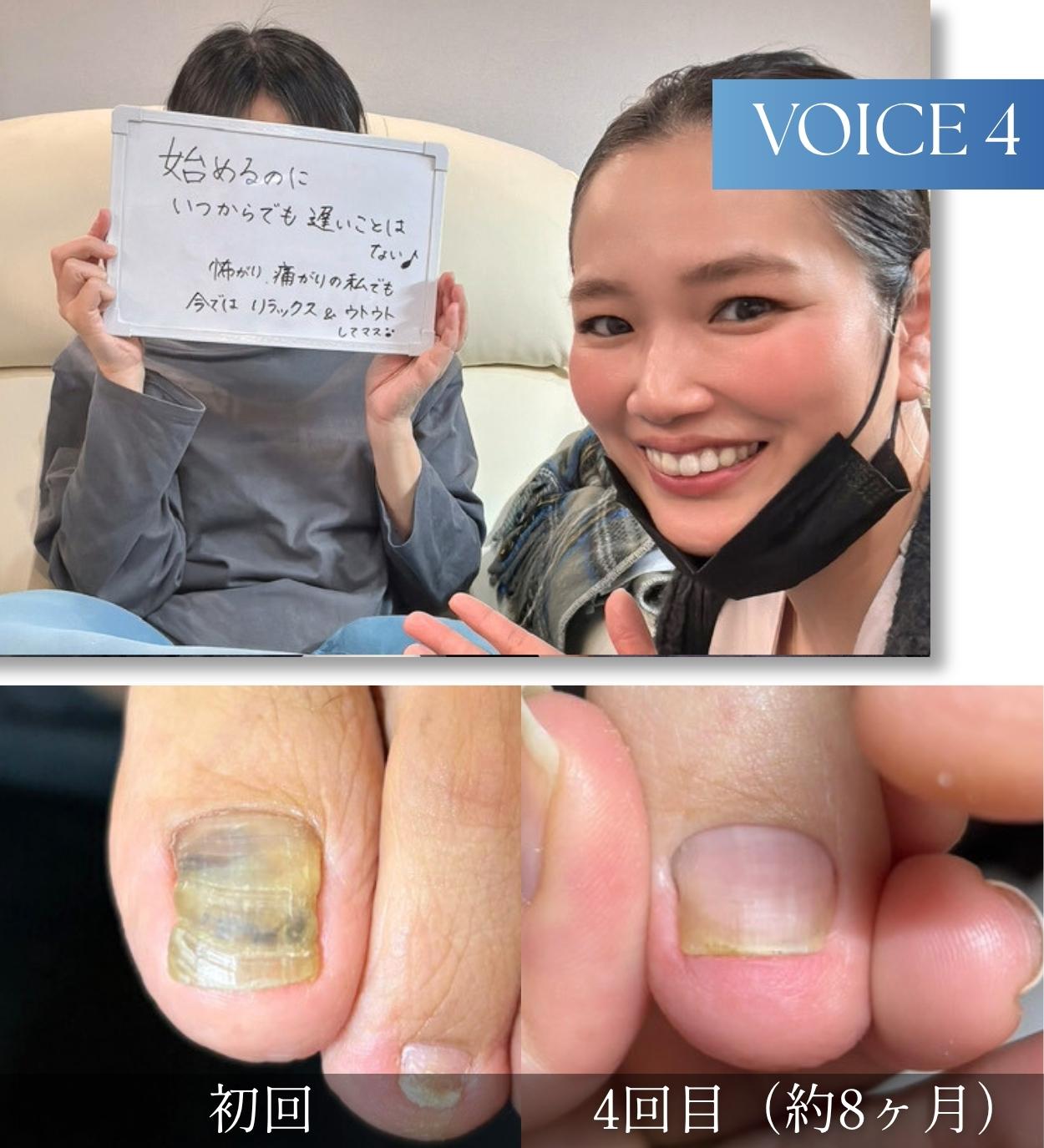 巻き爪・変色で悩んでいたお客様の声4